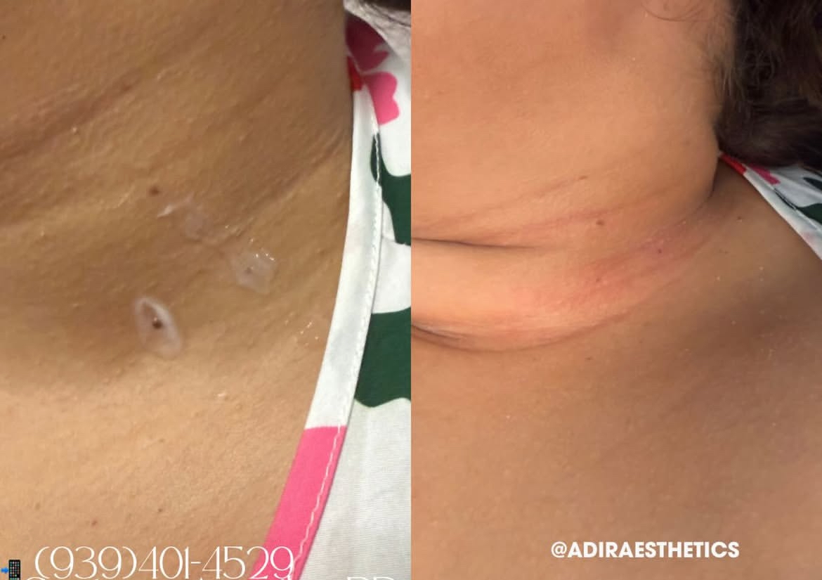 Remoción de Skin Tags