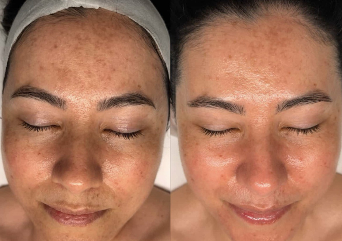 Peeling 👩🏻‍🔬 avanzado 