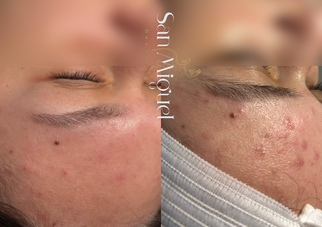 VISITAS SEGUIMIENTO: Estabilización del Acné 