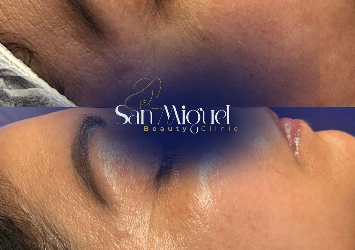 Dermaplaning + Limpieza Profunda 