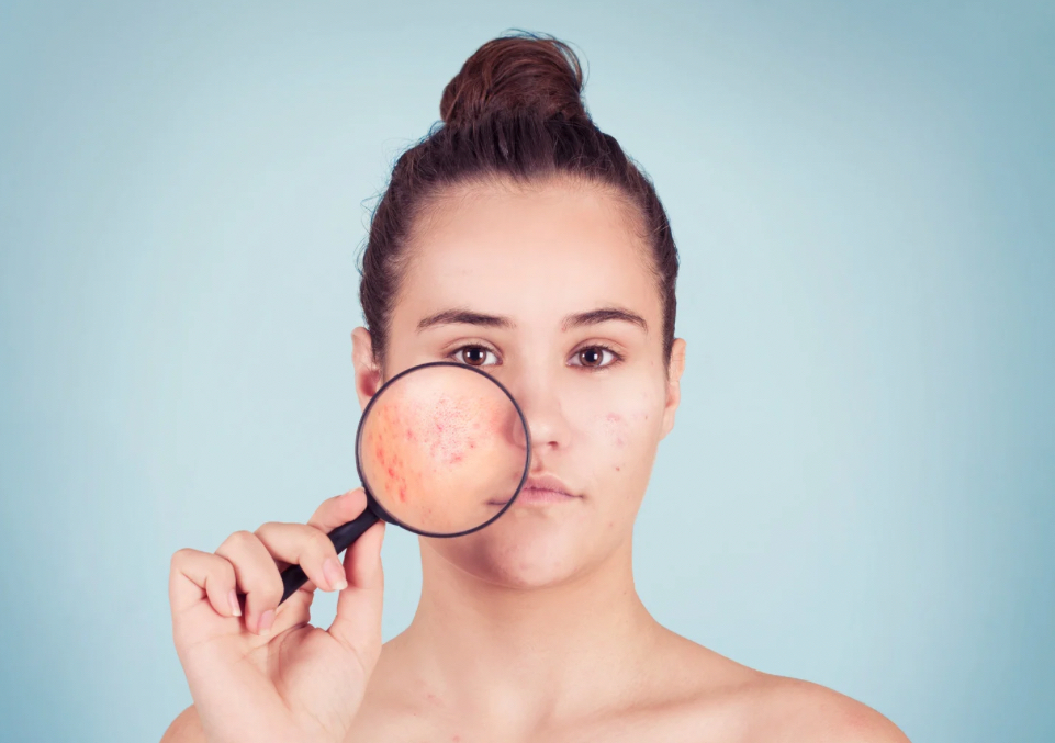 ACNÉ | Evaluación Inicial 🩵