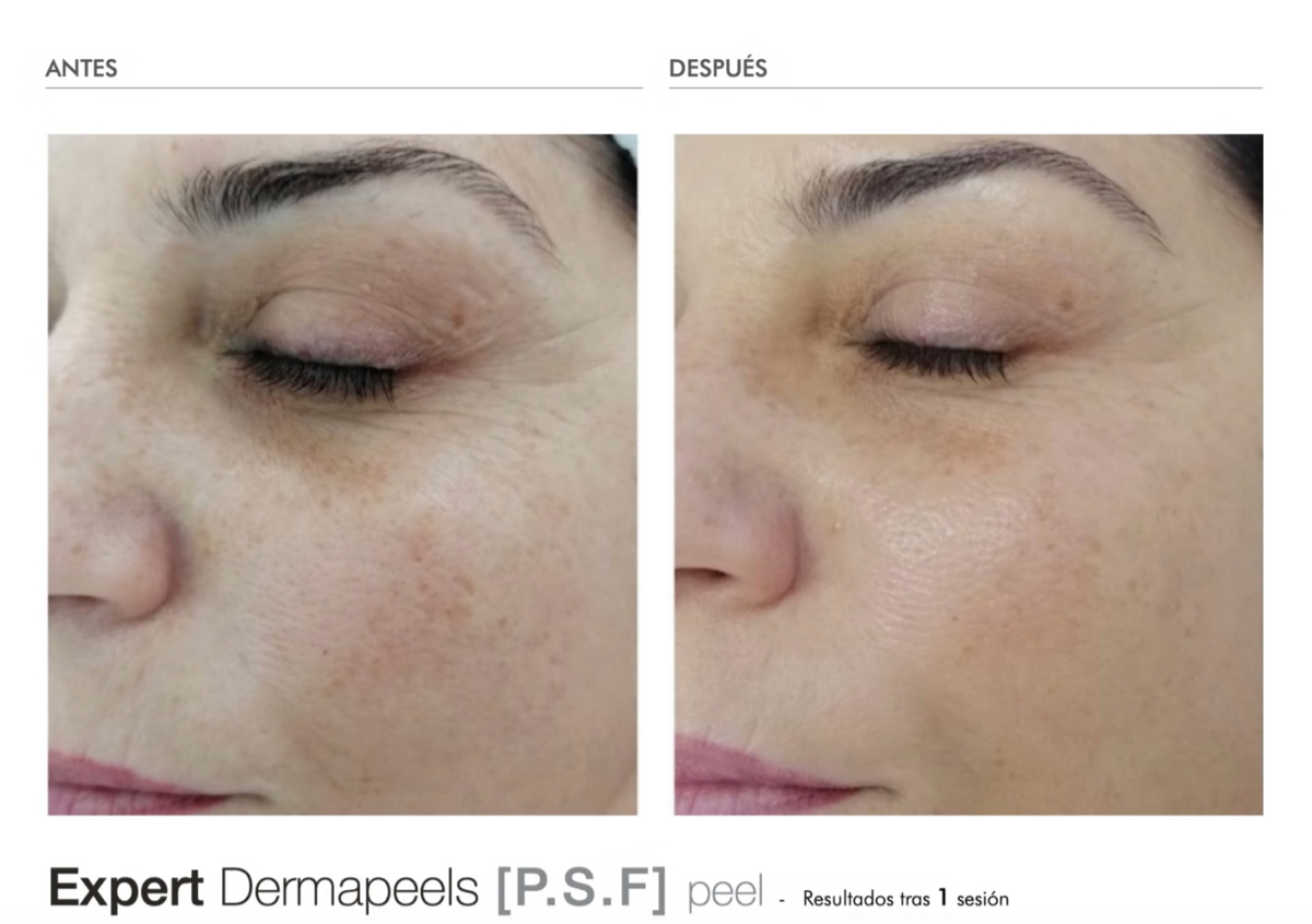 Tercera visita — Intensificación del tratamiento 