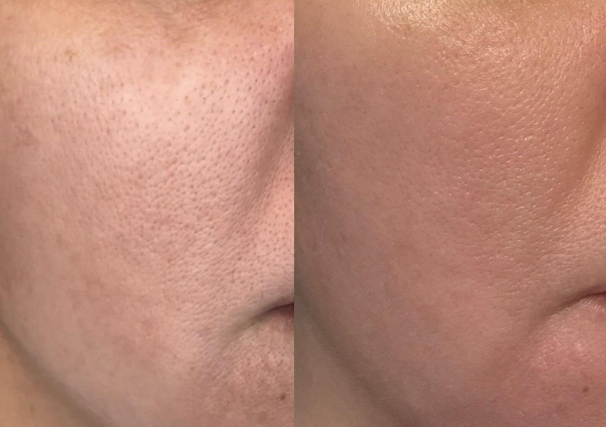 Dermapen facial con ADN de salmón