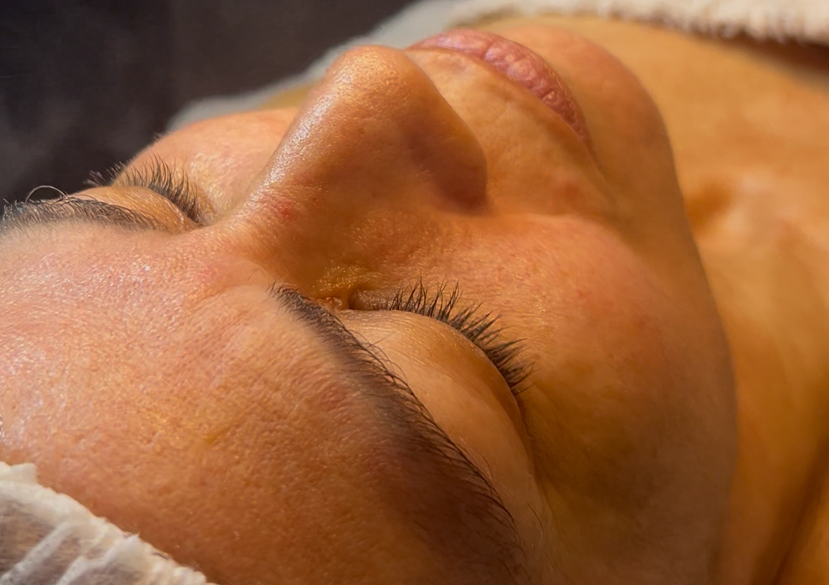 Microdermabrasion + Limpieza profunda 