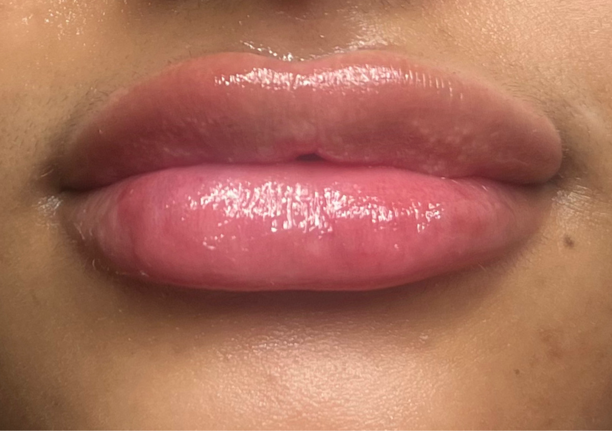 1ml Lip Filler