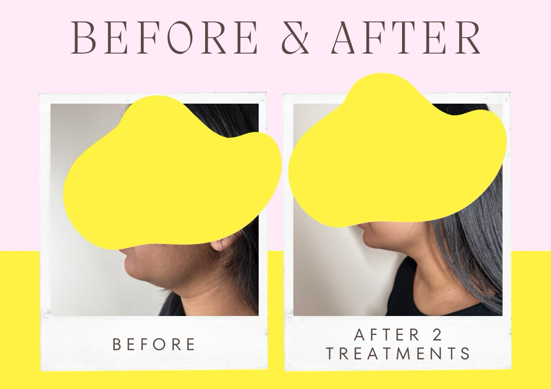 Chin Lemon Bottle Fat Dissolving  (single vial)