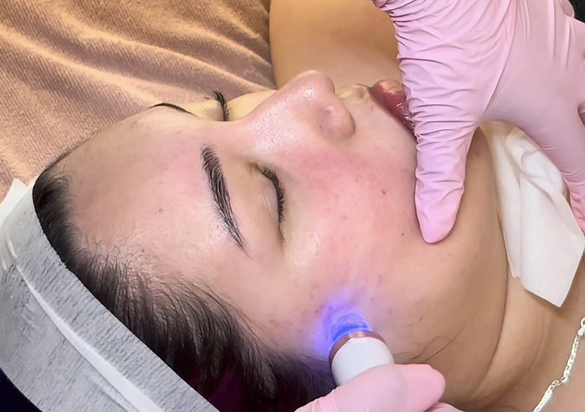 Hydrodermabrasion