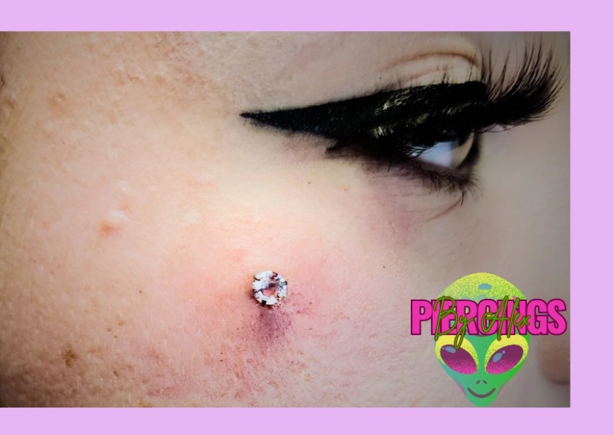 Surface anchor (Dermal)