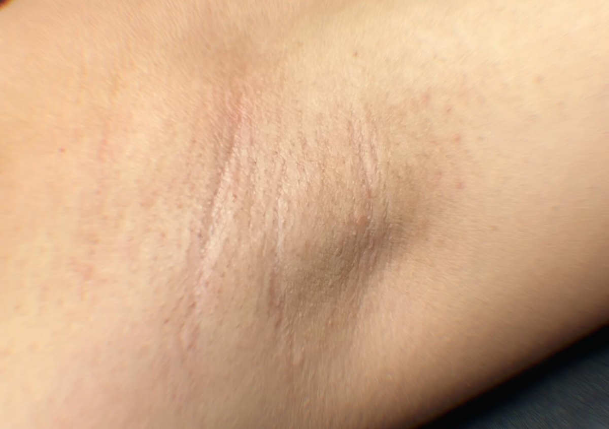 Axilas - epilacion cera