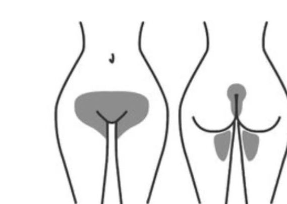 Depilación laser Brazilian