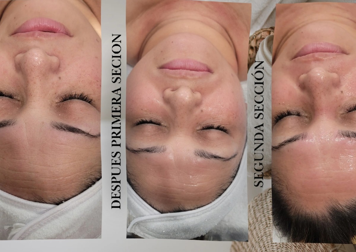 Peeling de verano para líneas de expresión 