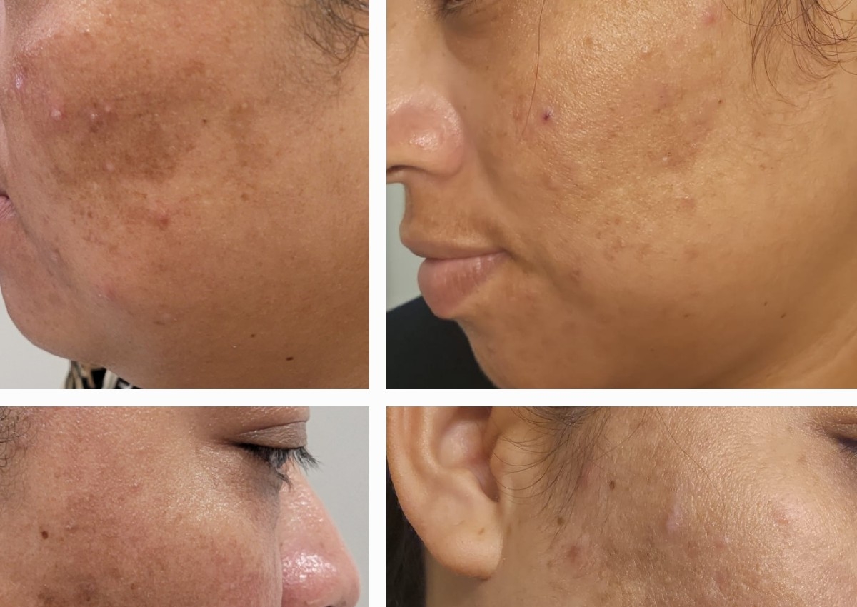 Tratamiento para manchas