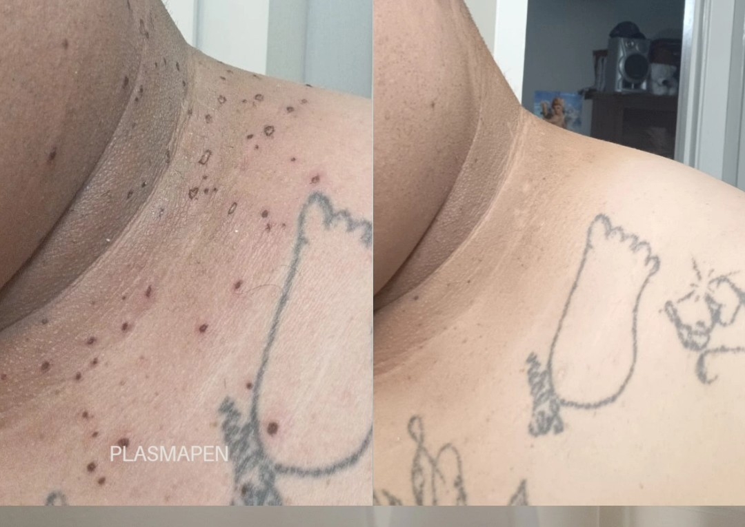 Eliminación de verrugas