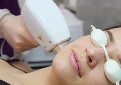 Mejillas (cheeks) depilacion láser 