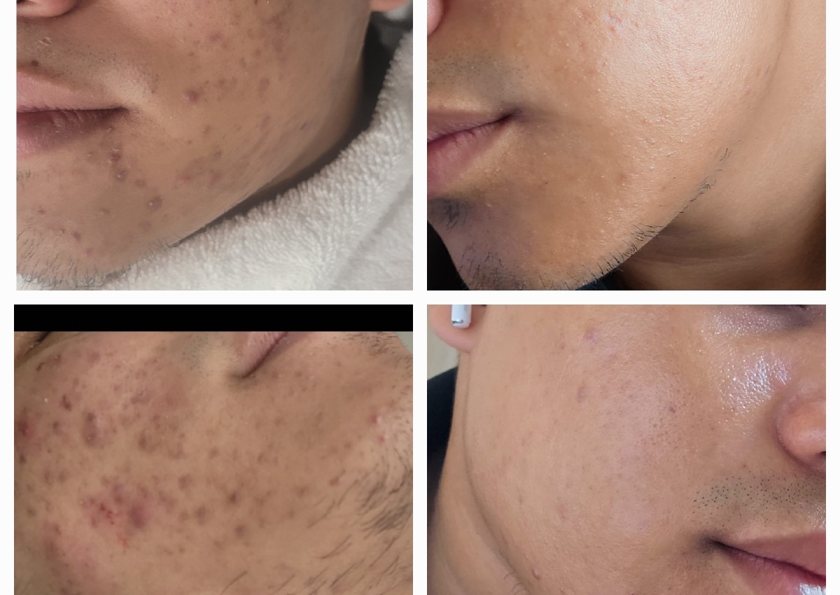 Tratamiento anti acne