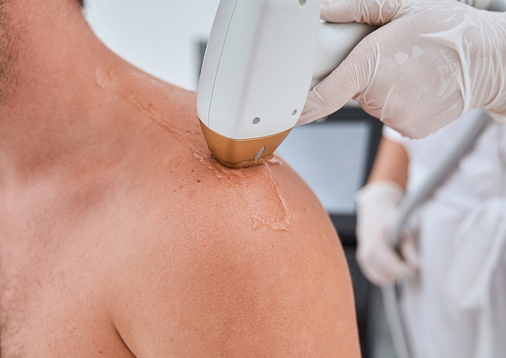 Hombros (Shoulders) depilacion laser 