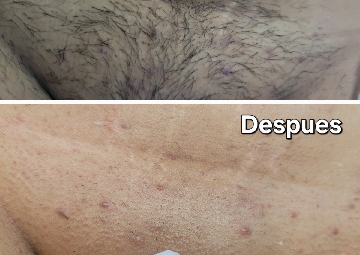 Waxing brazileño para mujeres)