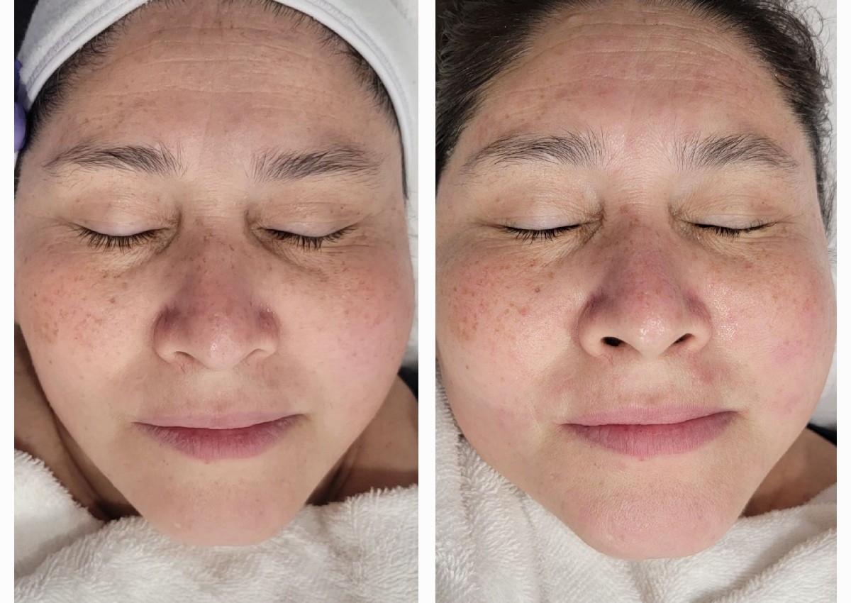 Tratamiento facial activo luminoso.