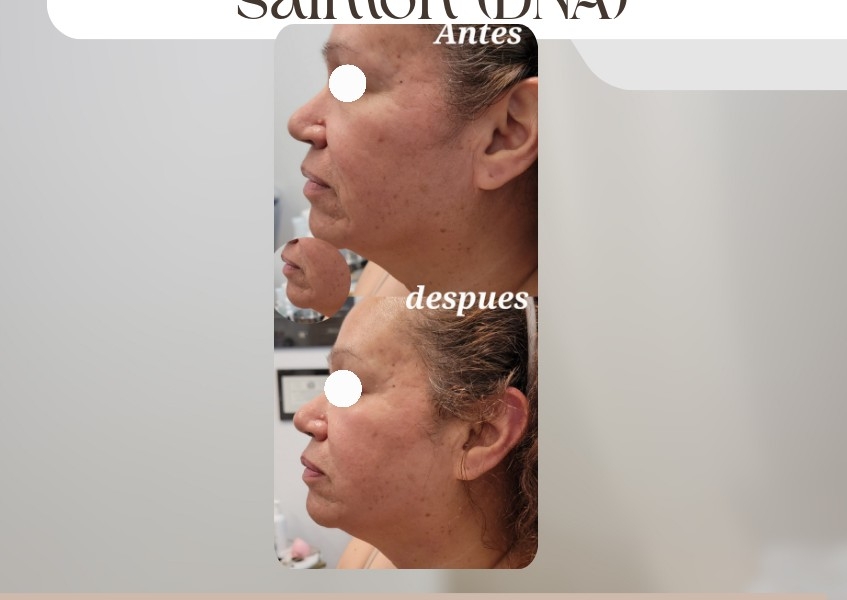 Radio frecuencia fraccionada  con enzimas de salmon