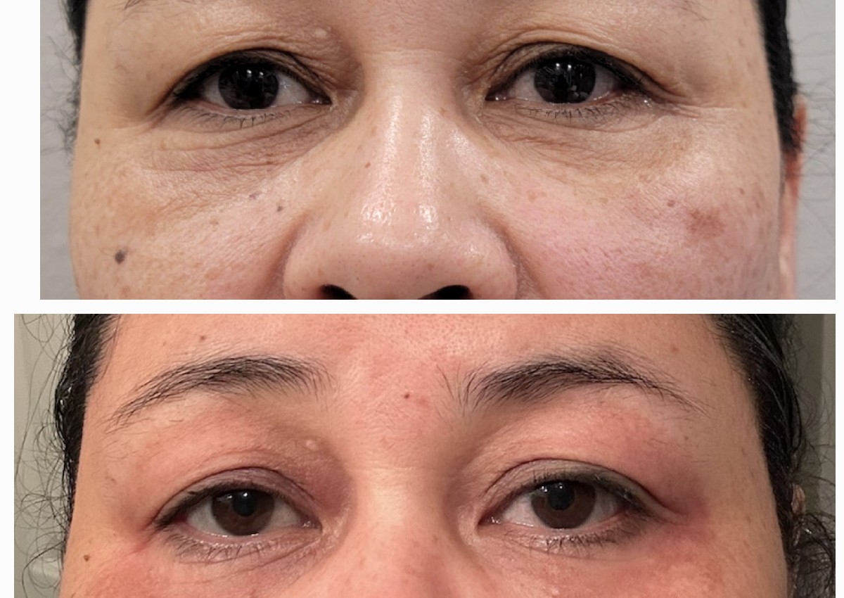 Tratamiento parpado caido 