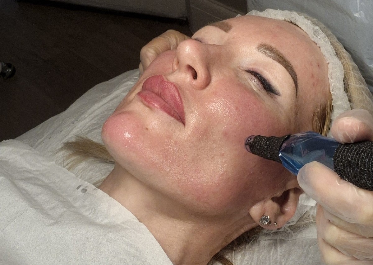 Microneedling