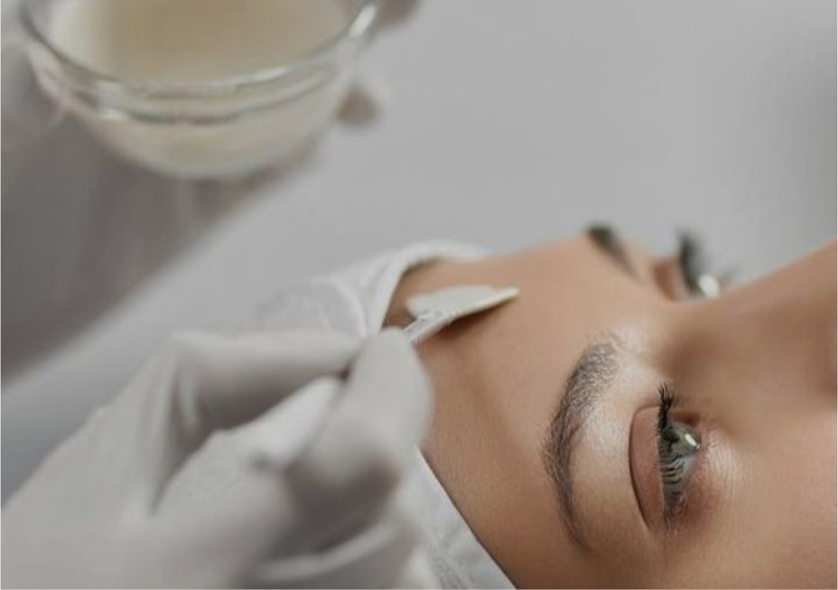 Chemical Peel