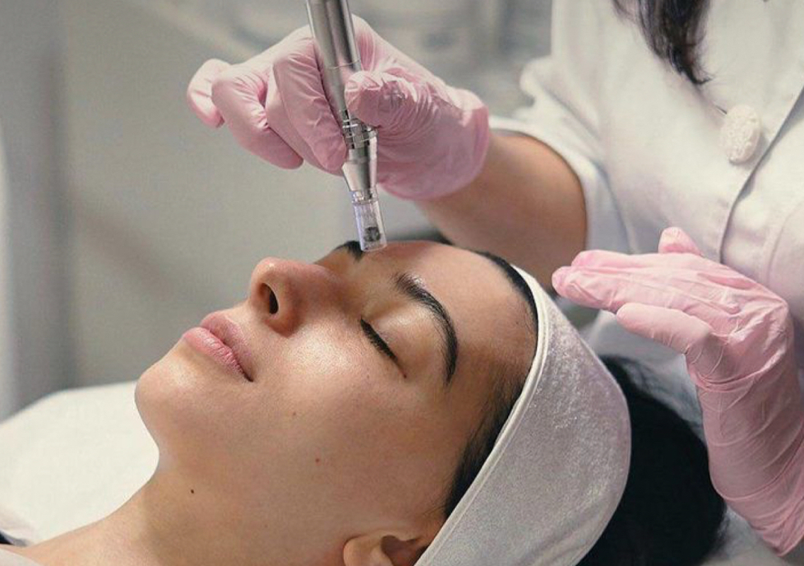 Microneedling