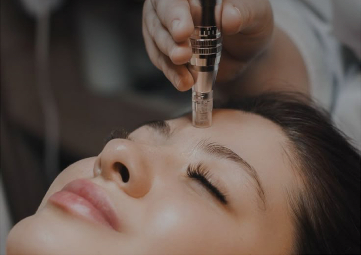 Microneedling + Exosomes