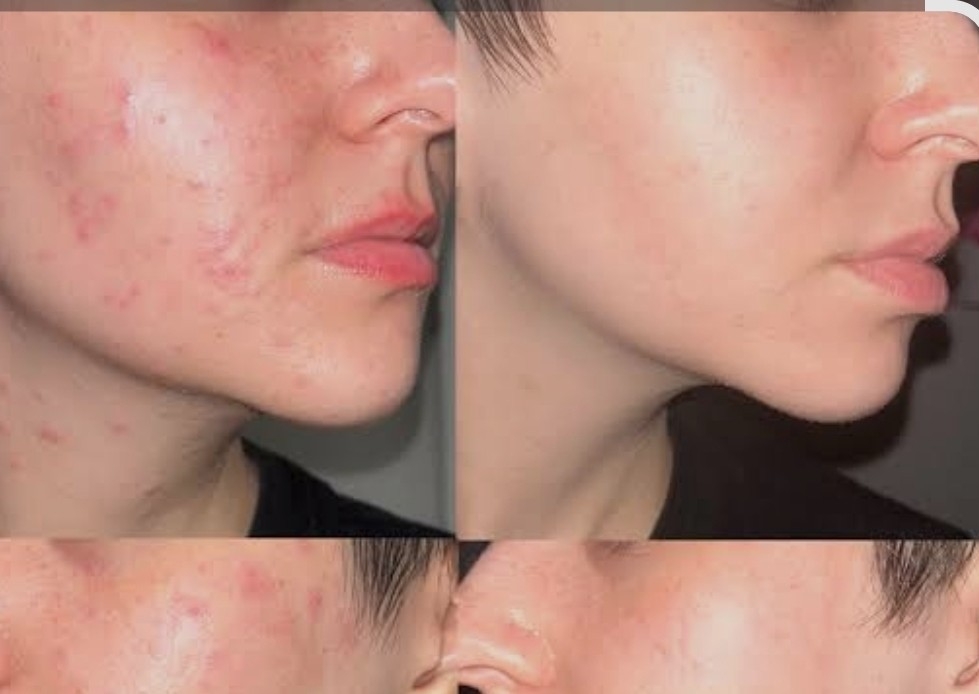 Facial de acné 