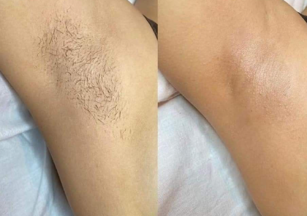 Depilación De Axilas