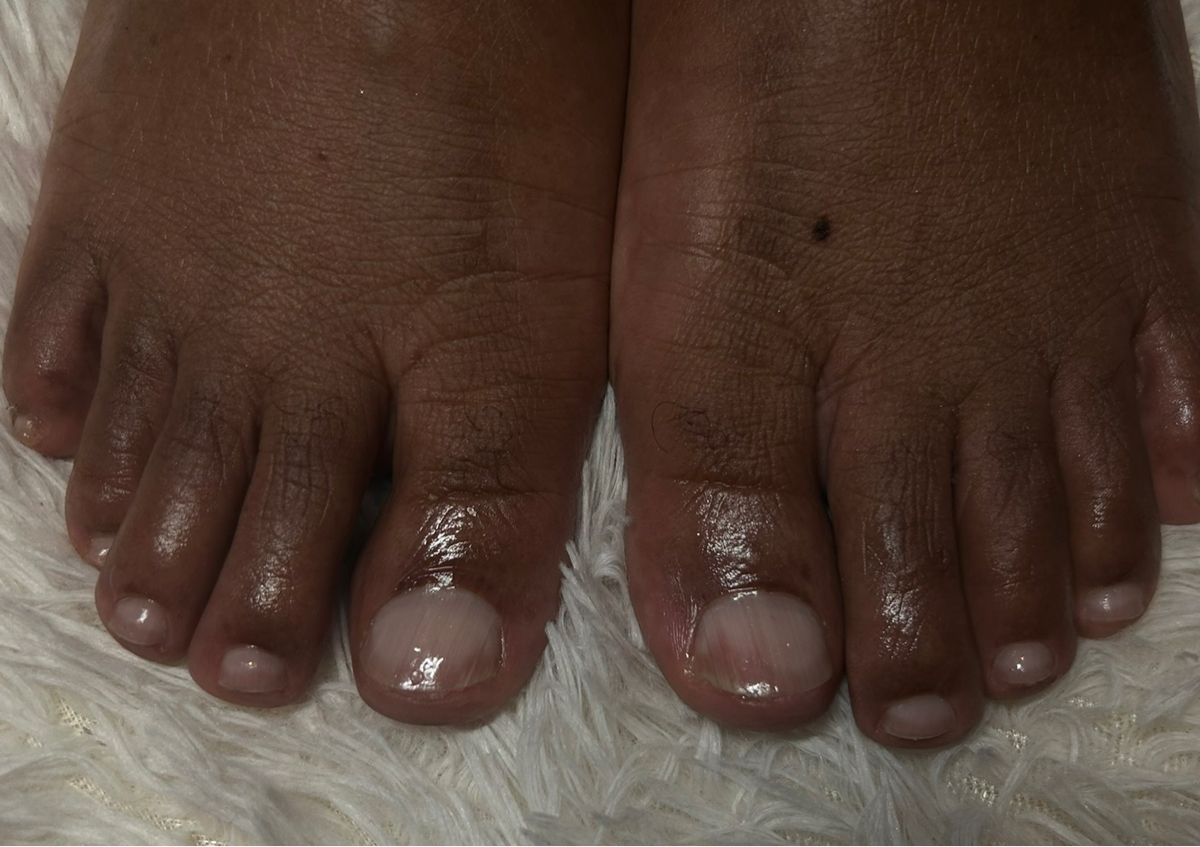 Gel Toes
