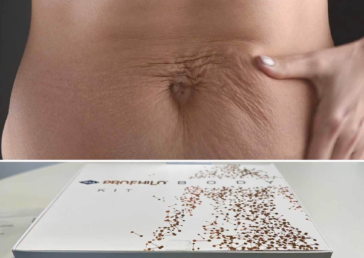 Profhilo Body ( 2 Treatments ) 