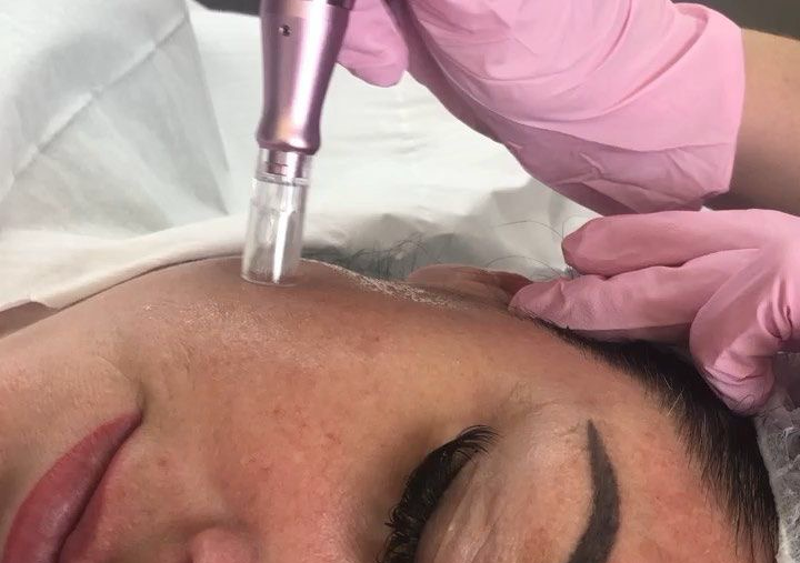 Microneedling Facial With Collagen and Vitamin