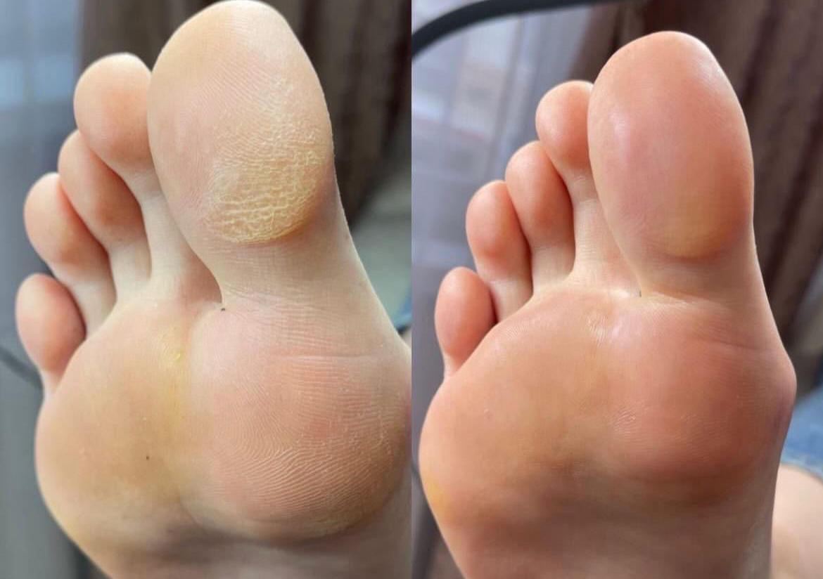 CURATIVO (talloni,calli,unghie incarnite)