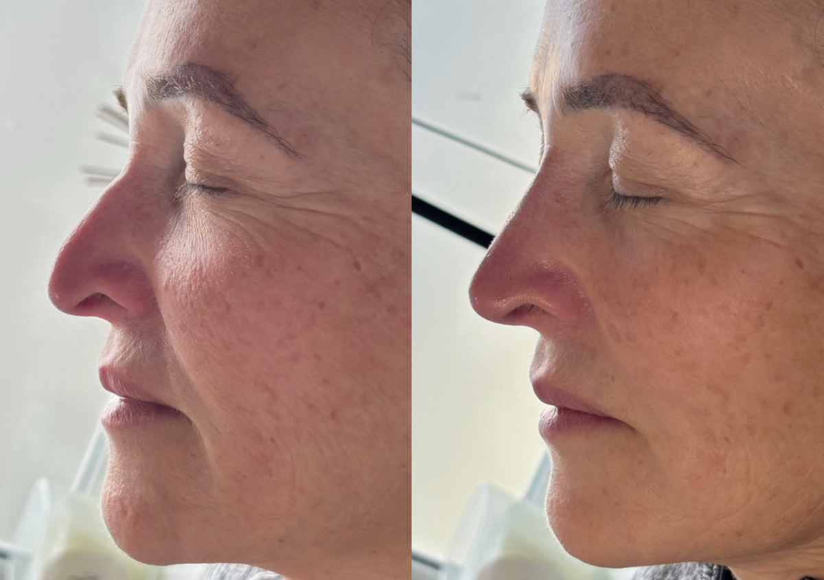 Liquid Rhinoplasty 