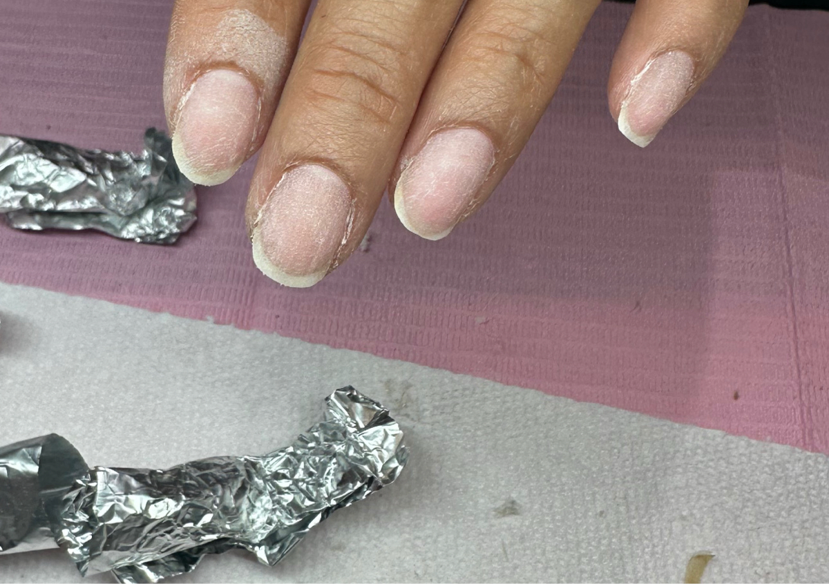 Nail Removal 