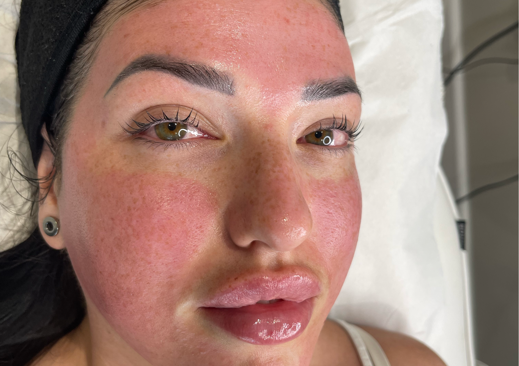 Microneedling Facial