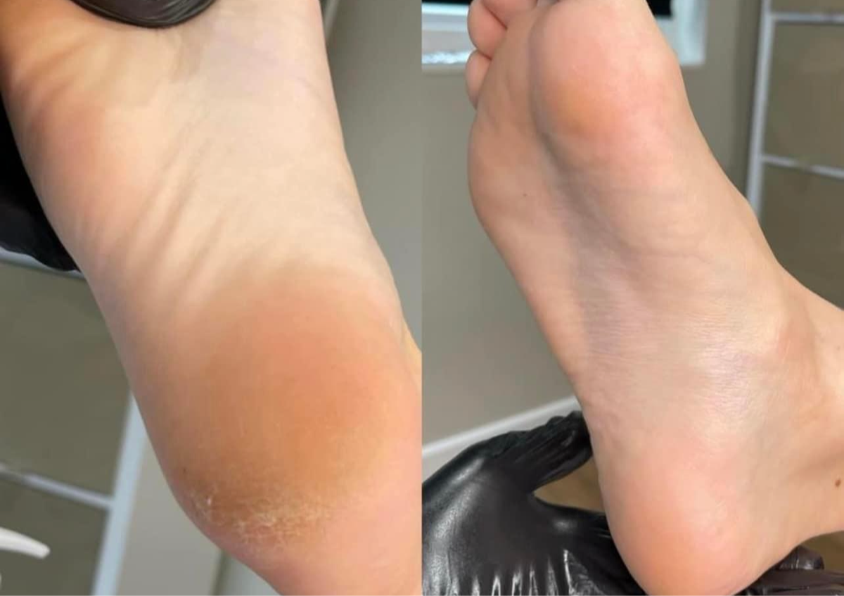 Elim pedicure (Medi Heel)  (no gel toes)