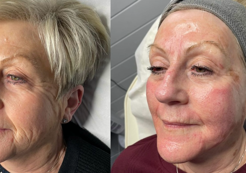 Skin Booster- Seventy Hyal 