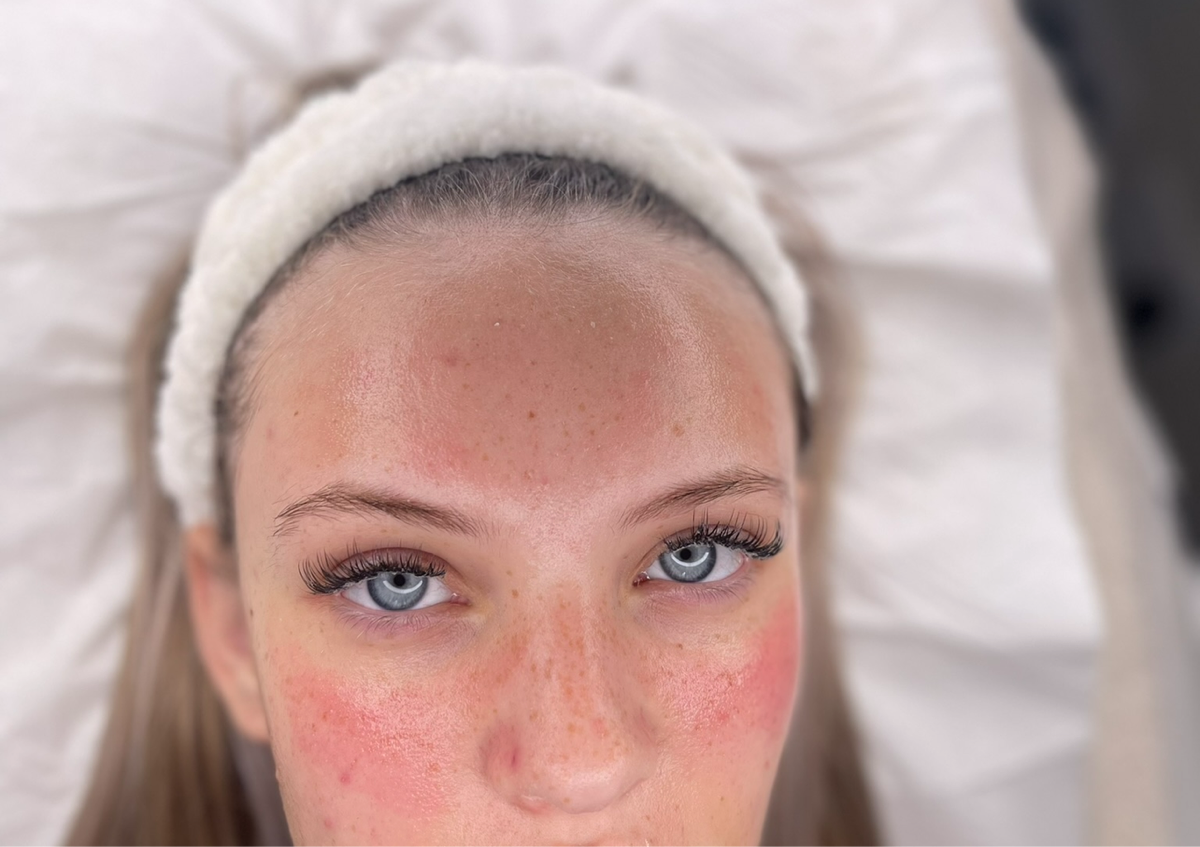 Glass Skin Facial with microneedling 