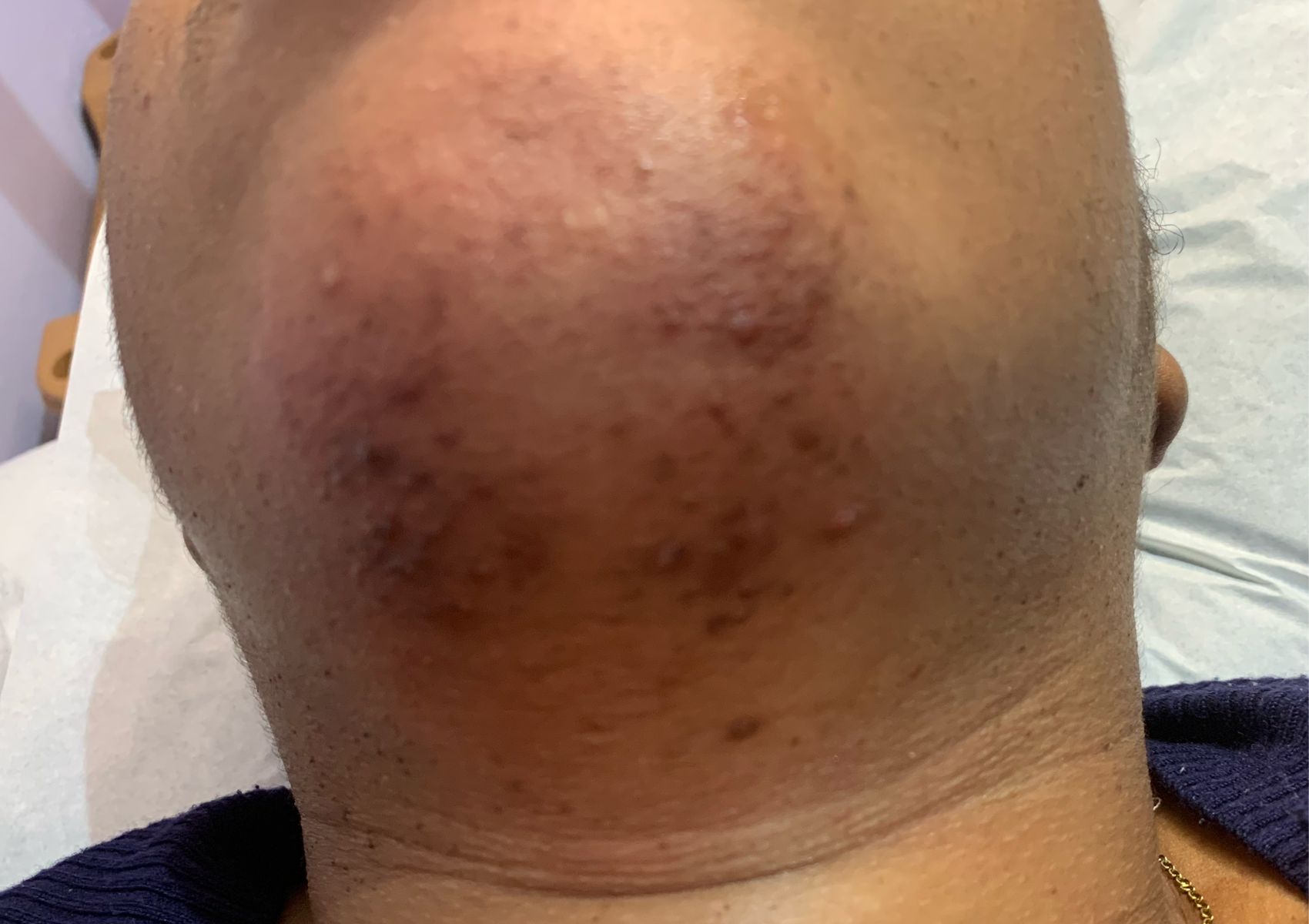 ▪️Under Chin Wax