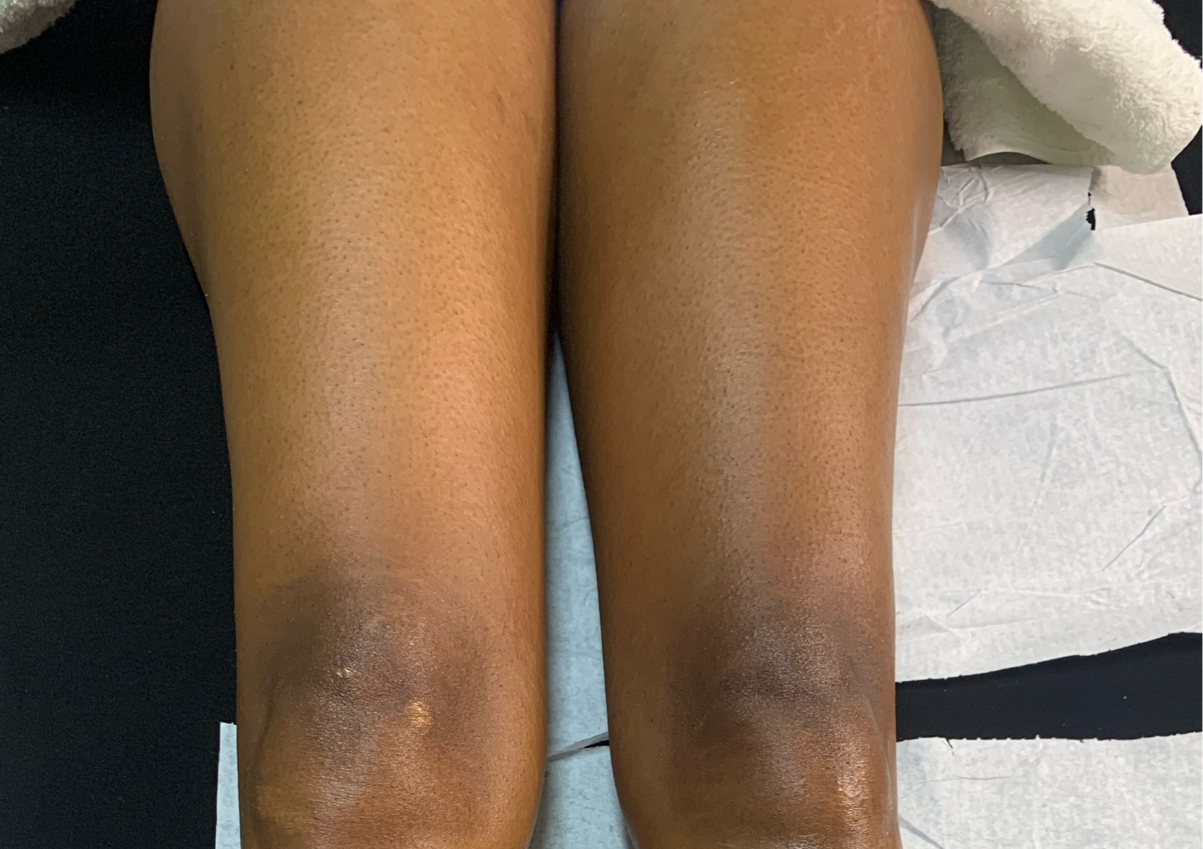 Half Leg - Thigh Area