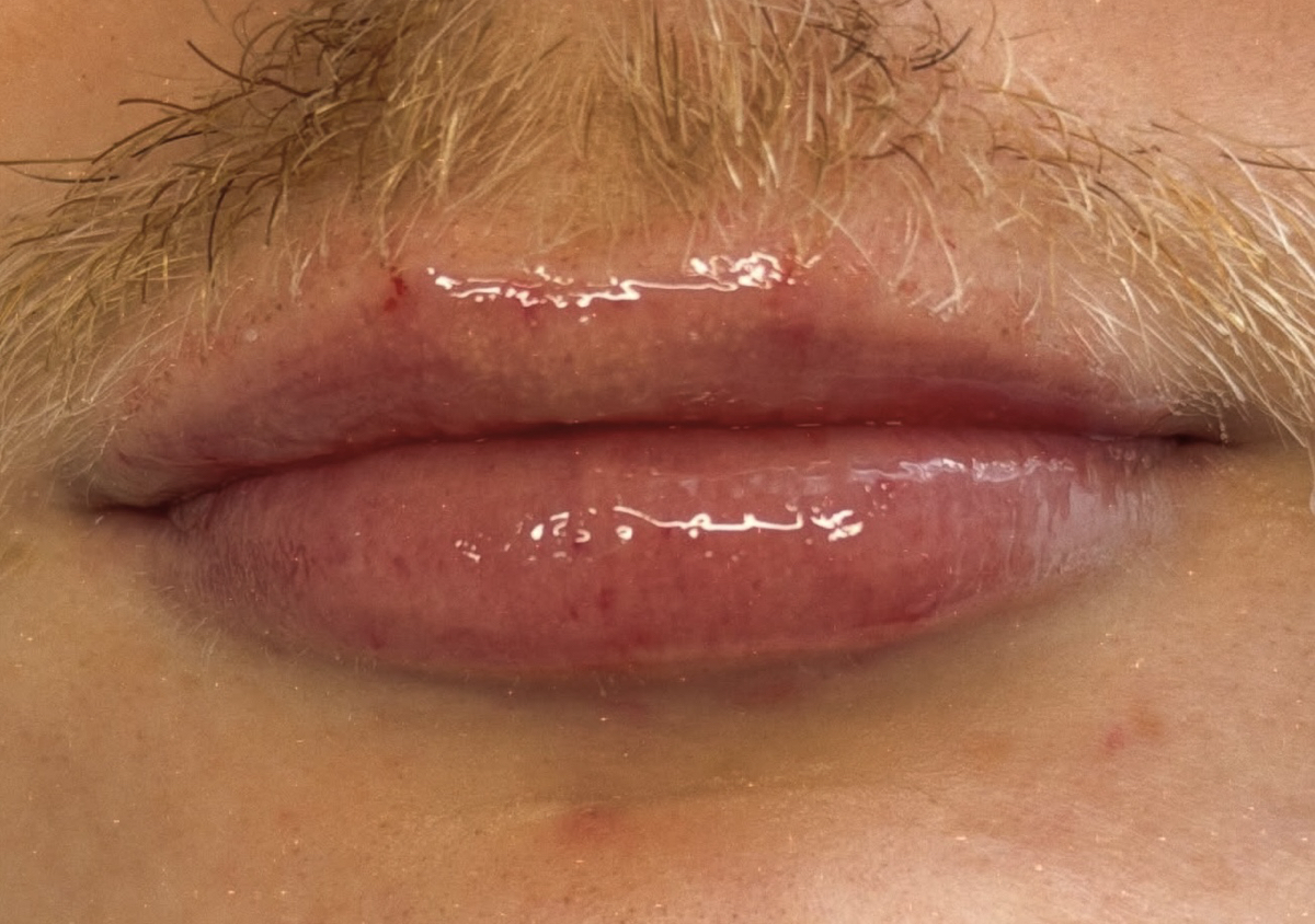 Lip Filler 0.5ml