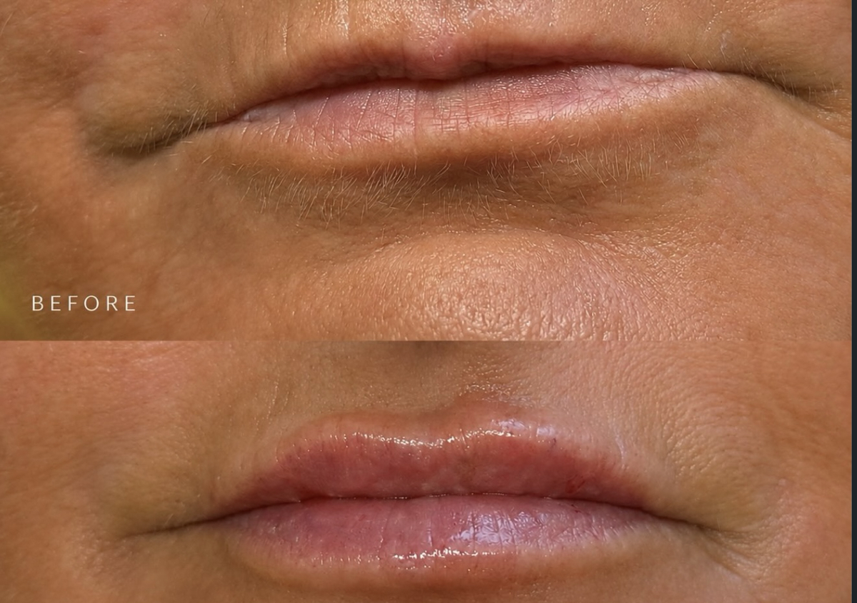 Lip Filler 0.7ml