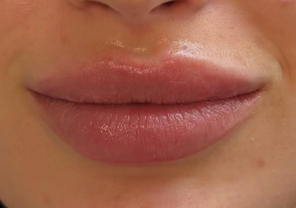 Lip Filler 1ml