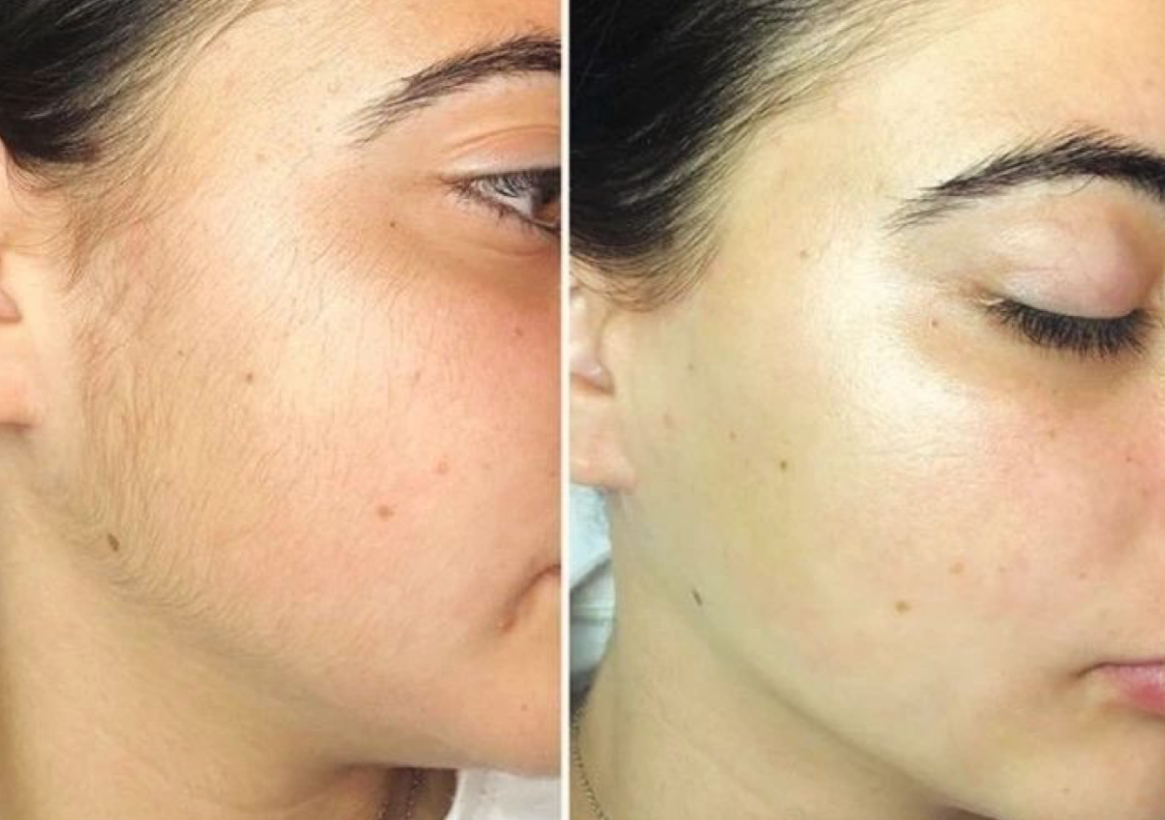 Depilacion Facial con Cera 