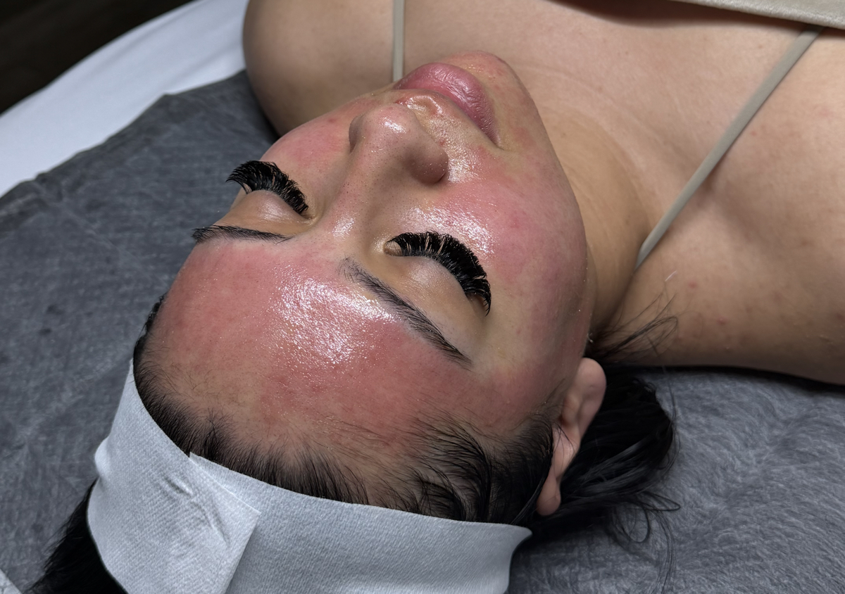 Microneedling
