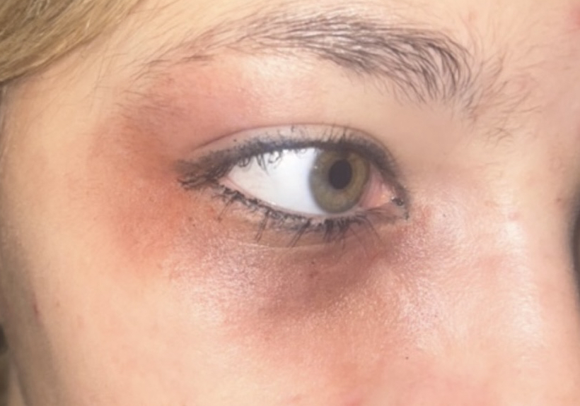 Makeup Bruise/Black Eye