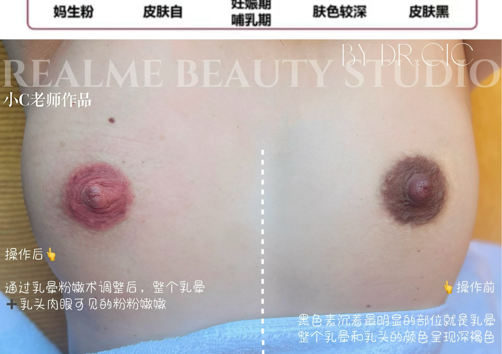 乳晕漂红Areola