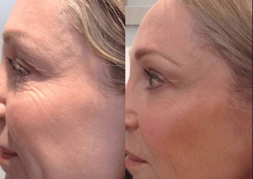 X1 Profhilo | SkinBoosters